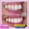 Alat untuk merapihkan gigi maju Alat perapih gigi tonggos original asli Perapih gigi maju ke depan Behel gigi lepas pasang karet murah Perapih gigi tonggos atas asli ginsul atas tidak rata asli Alat buat merapihkan gigi tonggos Teeth Trainer Alignment ORI. 