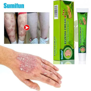 Chuyên dùng bôi ngoài da hắc lào lang ben nấm da mề đay viêm da cơ địa á sừng vảy nến tổ đỉa viêm da dị ứng viêm da dầu viêm da dị ứng ngứa nứt nẻ nước ăn chân tay