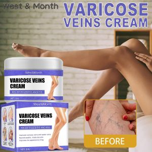 Varicose Vein Cream effective treatment of varicose veins Varicose veins Varicose Varicosity Varicose Vein Ointment Varicose Cream Varicose Remover Varicose Veins Remover Anti Varicose Anti Varicose Veins