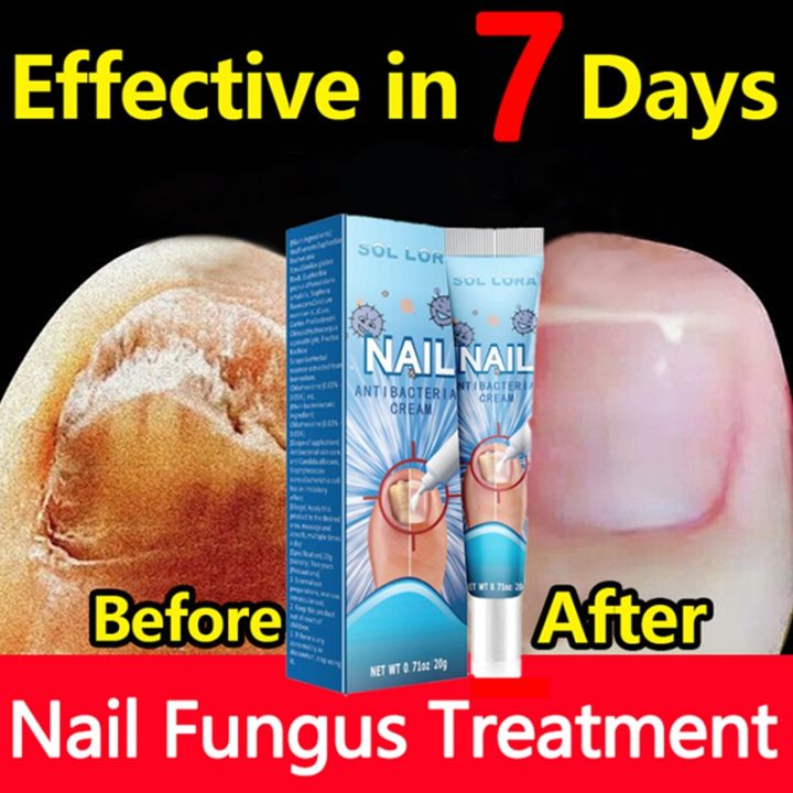 7day effective treatment of fungal paronychia with gray nails, removal