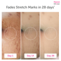 Mama’s Choice Stretch Mark Treatment Series | Stretch Mark Cream and Serum | No Paraben and Alcohol. 