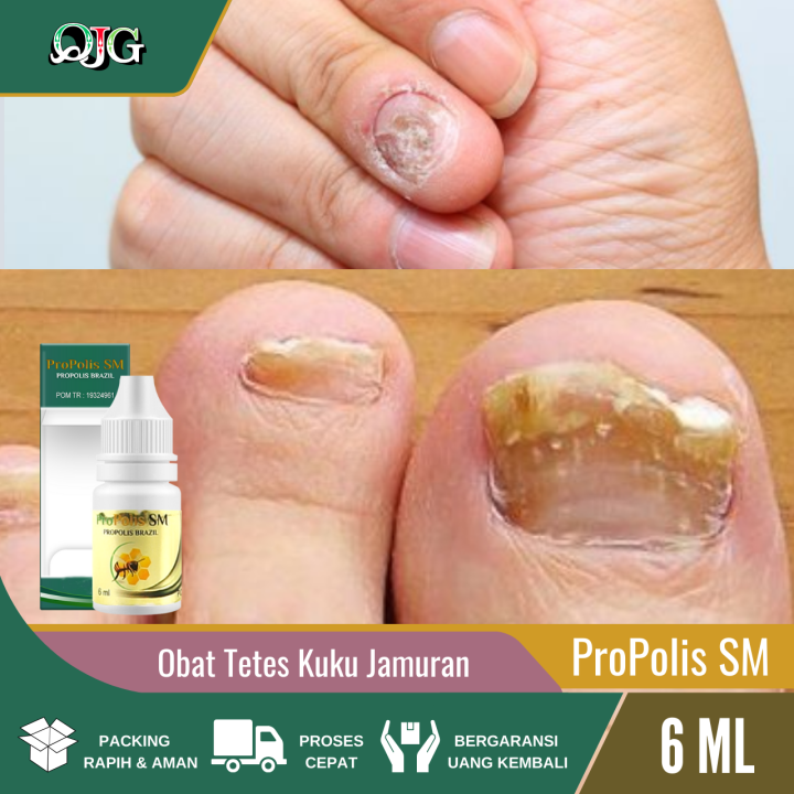 Propolis SM Obat Tetes Kuku Jamuran Rusak, Kuku Bau Busuk, Jamur Kuku ...