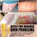 Natural Chinese Herbal Medicine Psoriasis Cream Eczema Psoriasis Antibacterial Antifungal Cream Ointment. 