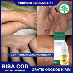 Obat Herbal Penghilang Koreng Salep Herbal Korengan Kaki -Tangan Borok Bisul Luka Hitam Cacar - Propolis Sm 100% Alami Terlaris