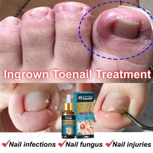 Ingrown Toenail Treatment for Nail Infections Fungus Injuries with Cream and Tool