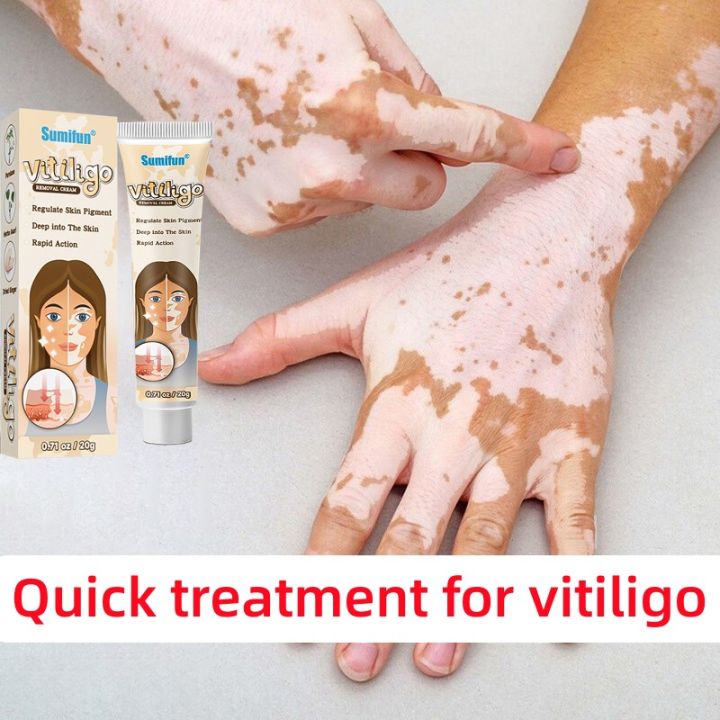 Vitiligo Treatment Cream Vitiligo Repair Cream Pigment Melanin Cream Vitiligo Treatment Cream Vitiligo Repair Cream Pigment Melanin Cream