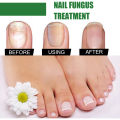 EELHOE Nail Fungus Repair Liquid Remove Onychomycosis Treatment Essence Serum Anti-infective Nourishing Brighten Foot Nail Oil Anti-Fungus Onychomycosis-Removal Liquid Ginger Foot Antifungal Nail Essence. 