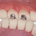 bite turbo bite dental peninggi gigitan anterior peninggian gigit ortho orthodontic behel gigi. 