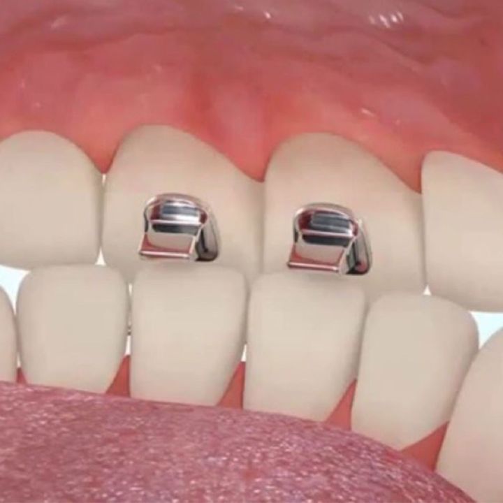 bite turbo bite dental peninggi gigitan anterior peninggian gigit ortho orthodontic behel gigi