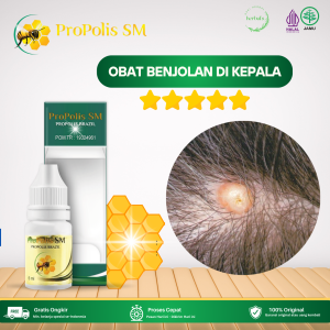 Obat Benjolan Di Kepala Obat Penghilang Benjolan Di Kepala Obat Pengecil Benjolan Lipoma Di Kepala Obat Benjolan Lunak Di Kepala Obat Benjolan Abnormal Di Kepala Obat Nyeri Benjolan Di Kepala Dengan Propolis SM