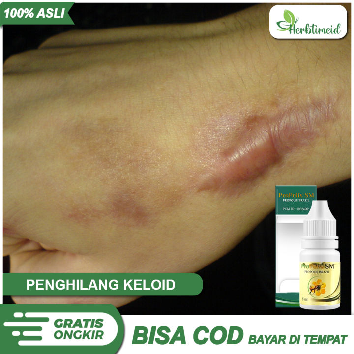 Obat Untuk Menghilangkan Keloid Penghilang Bekas Luka Operasi yang