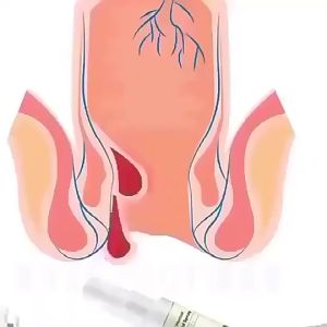 in stock Hemorrhoids cream Krim Buasir Hemorrhoids spray Treatment of mixed internal and external hemorrhoids Relieve itching