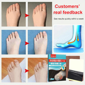 biaozhen Hallux valgus correction patch specially designed for large foot bones to correct foot shape