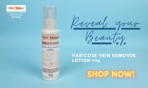 BEST VARICOSE REMOVER IN CHINA. Natural Ingredients. Glee Skin - Perfect Legs Varicose Veins Remover Lotion Effective & Original Cream Original Vasculitis Phlebitis Spider Pain Relief Medical Plaster Chinese Natural Herbal Medicine For Treating Varicose.
