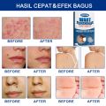 Plester Kutil Mata Ikan untuk Kaki Kapalan Foot Corn Removal Plaster Koyo Penghilang Mata Ikan12pcs plester mata ikan,obat mata ikan di telapak kaki,plaster mata ikan. 