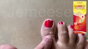 Jemeesen Foot Corn Remover Stickers Painless Plaster for Chicken Eye & Callus Removal Effective Foot Care Treatment for s