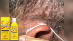 Sulfur Oil-Control Anti-Dandruff Shampoo Gentle Cleansing Itch Relief Formula Repair Dry & Frizzy Hair Refreshing Volumizing Root Care Deep Cleansing Scalp Savior