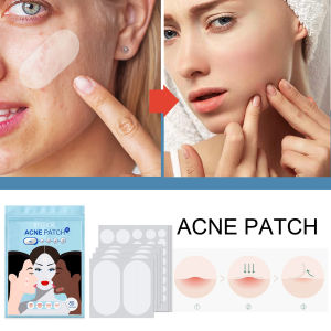WOOLOVE 80 Pcs Acne Pimple Patches Stickers Acne Spot Treatment Skin Tag Remover Patch Blemish Spot Facial Mask Hydrocolloid Bandages