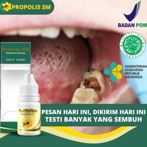 Obat Gigi Bolong Obat Gigi Goyang Obat Akar Gigi Obat Penghancur Gigi Berlubang Gigi Obat Sakit Gigi Berlubang Plak Gigi Periodontitis Obat Gigi Anak Obat Gigi Hitam Pada Anak Gingivitis Abses Gigi Perikoronitis Bau Mulut Gusi Berdarah