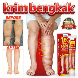 krim bengkak 20g leg edema cream ubat surut bengkak kaki membantu melancarkan darah kurangkan bengkak dan kesakitan 消肿膏