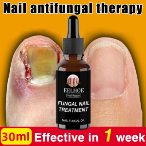 Nail Treatment Feet Care Essence Nail Foot Whitening Toe Nail Fungus Removal Gel Anti Infection Paronychia Onychomycosis/ Obat Kuku Rusak /obat Kuku Berjamur /obat Jamur Kuku 30ML