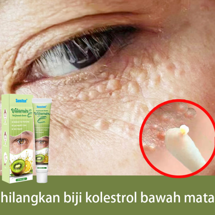Vitamin E eye cream hilangkan biji kolestrol mata remove milia seed Fat