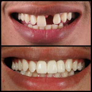 [ 2 PCS/BUNGKUS ] Super Kuat penambal gigi ompong  Gigi Palsu Penutup Ompong Depan Bawah Penambal Gigi Ompong Berlubang Patah Penambal gigi renggang permanen Temptooth Temporary Tooth Asli 100% Original Aman Temptooth Bahan Gigi Palsu Ori Murah Isi Banyak