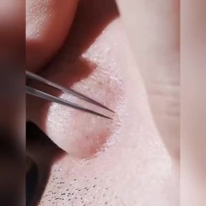 Ultra-Fine Precision Acne Blackhead Remover 4-Piece Set Pimple Extractor Blemish Tool With Iron Portable Storage