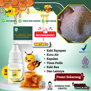 Obat Kaki Rayapan Dan Bau Telapak Kaki Bolong Bolong Kutu Air Kaki Jamuran Tinea Pedis Rorombeheun Kaki Pecah Pecah Kapalan Pembersih Kulit Mati Kaki - Propolis SM PALING AMPUH Namun Hasilnya Tidak Sama di Setiap Tubuh