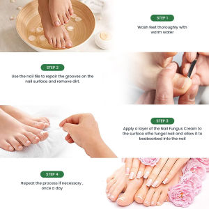 new 20g Nail Fungus Treatment Cream Finger Toe Nail Fungal Removal Plant Extraction Anti Infection Paronychia Onychomycosis Care hot
