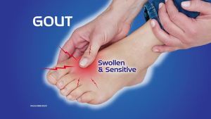 ClearogoutGoutPainReliefSupplementNeutralizeUricAcidSugarFreeSakitSendiKakiTangan