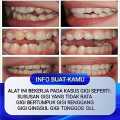 Alat untuk merapihkan gigi maju Alat perapih gigi tonggos original asli Perapih gigi maju ke depan Behel gigi lepas pasang karet murah Perapih gigi tonggos atas asli ginsul atas tidak rata asli Alat buat merapihkan gigi tonggos Teeth Trainer Alignment ORI. 