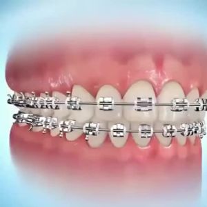 Set 10 bàn chải kẽ vệ sinh răng niềng tăm nha khoa bàn chải kẽ răng vệ sinh răng miệng chữ