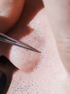3PCS Blackhead Remover Tweezers Set Ultra Sharp Acne Clip Stainless Steel Precision Tool Beauty Kit