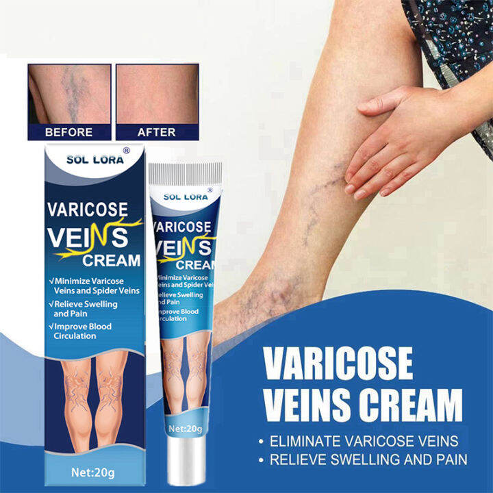 Improving Blood Circulation Venous Ointment Varicose Vein Cream ...