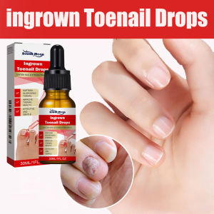  Serum Tẩy Nấm Móng Tay Chân Thảo Mộc Giúp Loại Bỏ Nấm Kháng Khuẩn Phục Hồi Móng Cứng Chắc Khỏe