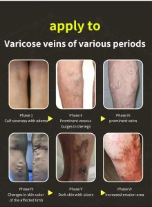 geegofirst Varicose vein repair massage cream Leg Massage Cream