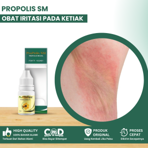 Obat Iritasi Pada Ketiak Obat Ketiak Gatal Obat Ketiak Lecet Dan Perih Gatal Merah Pada Ketiak Ketiak Berjamur Dan Kurap Obat Bintik Merah Di Ketiak Dengan Propolis SM