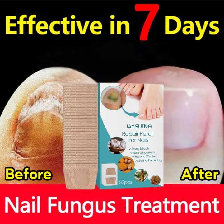 %E3%80%90100%25%20Effective%E3%80%91Jaysuing%20Fungal%20Nail%20Treatment%20Patch%20Anti%20Infection%20Paronychia%20Thickening%20Soft%20Waterproof%2032pcs%20-%20Image%202