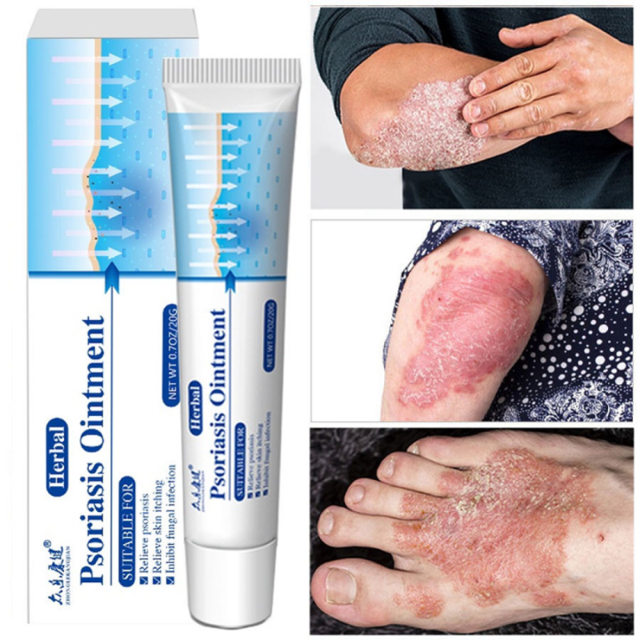 100% Effective Psoriasis Ointment Psoriasis Eczema Cream Psoriasis