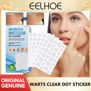 Eelhoe Face Care Skin Tag Beauty Health Mole Wart Removal Rubber Bands Skin Tag Removal Kit Micro Skin Tag Band Label Removal Device Rubber Ring Remove Wart Nevus Corns Remove Wart Paste Skin Care Tool Beauty