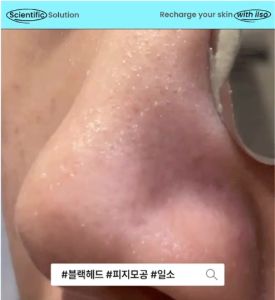 Ilso Super Melting Sebum Softener 150ml #1 Pore & Sebum Cleaner 6M+ Sold Blackhead & Whitehead Remover