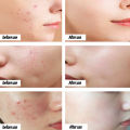 Acne Cream whitening moisturizing cream acne removal essence 30g facial essence cream scar acne remo Pimple Eraser. 