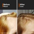 Minimalist 18% Hair Density Serum | Procapil, Capixyl, Redensyl & Anagain for Hair Growth & Hair Fall Control | For Men & Women | 30 ml. 