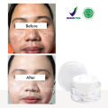 Penghilang Flek Hitam Paling Ampuh BPOM Salep Flek Hitam Ampuh Untuk Menghilangkan Flex Hitam Melasma Salep Flek Melasma Membandel Krim Penghilang Flek Hitam Di Wajah Permanen Cream Flek Khusus Flek Bandel Glowing Cream Leika Penghilang Flek Hitam Melasma. 