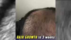 2/3/4pcs MBA Hair Growth Serum Derma Scalp Intensive Ampoule Triple Roll Massager Fast Regrow Hair Line Anti Hair Loss Essence