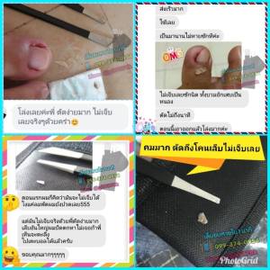 ที่ตัดเล็บขบด้วยตนเองแบบไม่เจ็บพร้อมคู่มือและคลิปสอนอย่างละเอียด