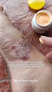 【Ship in 24H】BaiYaoLang Antibacterial Cream 20g Suitable For Skin Itching Insect Bites Antibacterial Itch Relief Eczema Treatment For Facial And Body Problematic Or Dry Skin Suitable