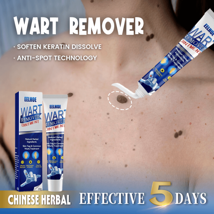 Warts Remover Original Watson Warts Removal Kasoy Oil Warts Remover Legit Mole And Warts Remover