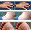 Obat Kutil Paling Ampuh Wart Remover Krim Penghilang Kutil Salep Kutil Penghilang Kutil Wajah Menghilangkan Kutil Filiform. 
